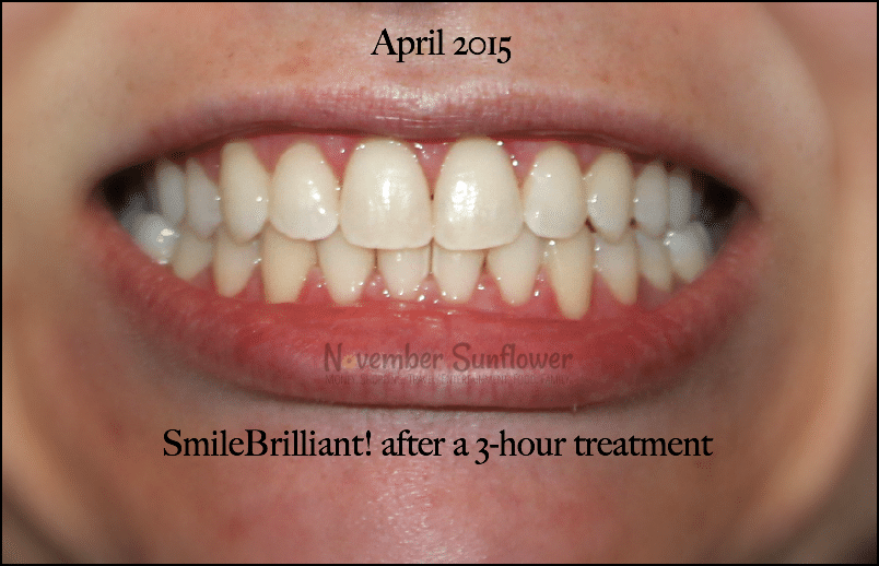 SmileBrilliant teeth whitening journey continues in April 2015 #smilebrilliant #teethwhitening #ad #beautyreview