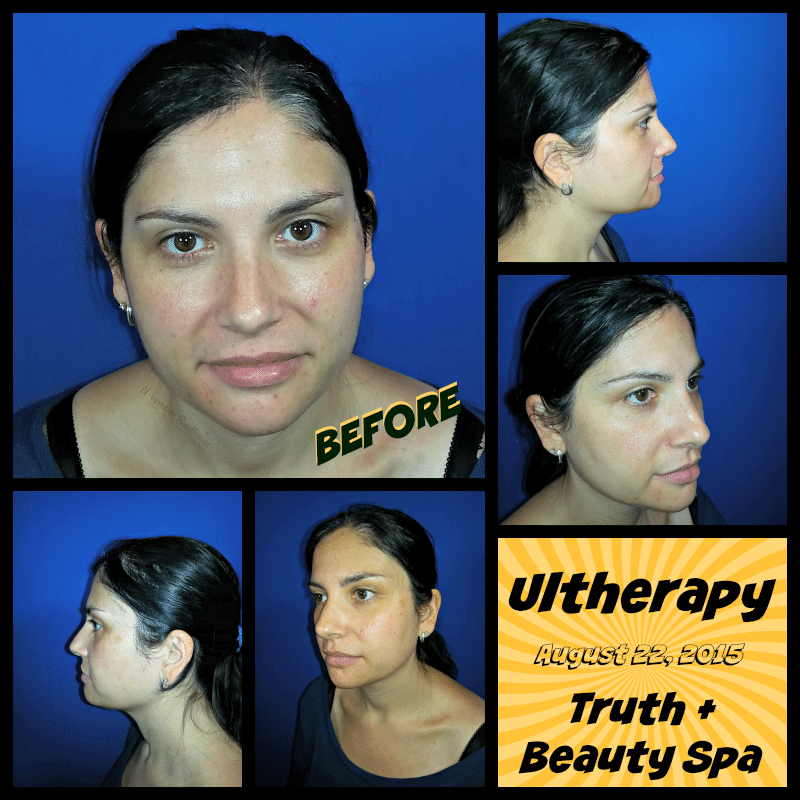 Ultherapy BEFORE at Truth + Beauty Spa 