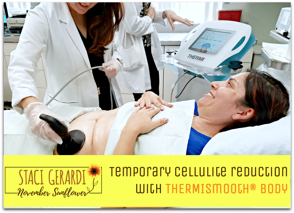 Temporary cellulite reduction with THERMIsmooth® body