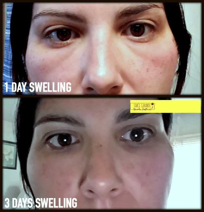 IPL Swelling Progression 