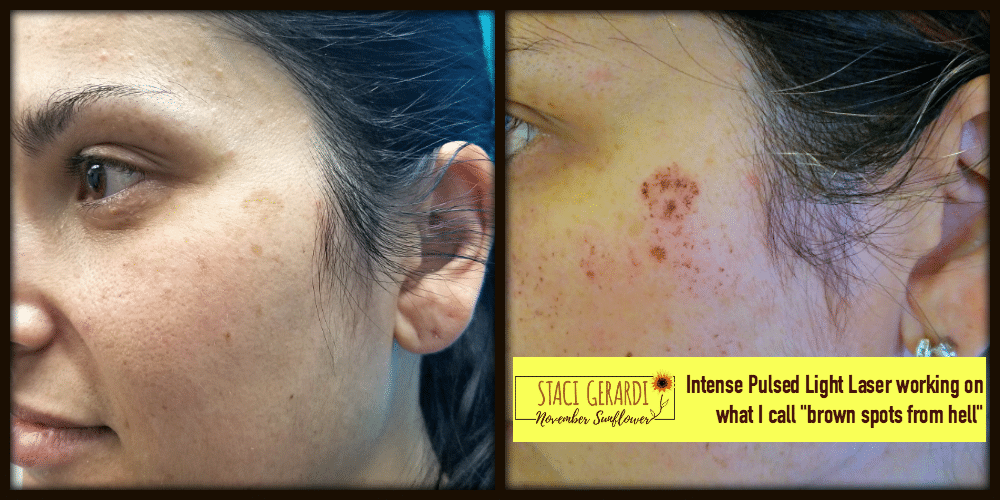 Age/Brown Spot Removal, Intense Pulsed Light - IPL