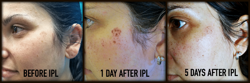 Intense Pulsed Light Progression - IPL