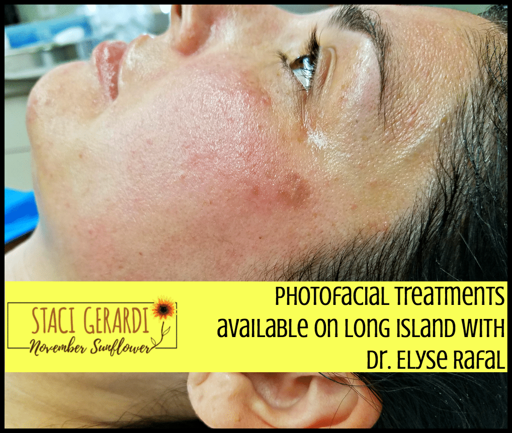 Photofacial treatments available on Long Island with Dr. Elyse Rafal 