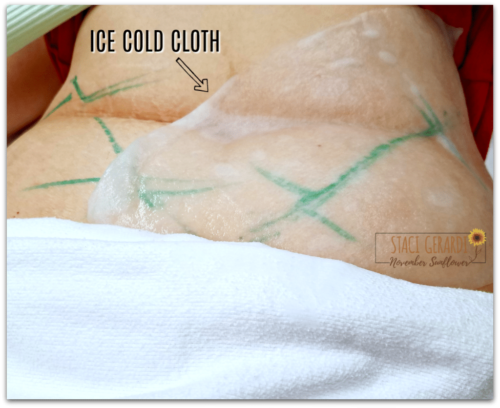 Numbing cloth for CoolSculpting