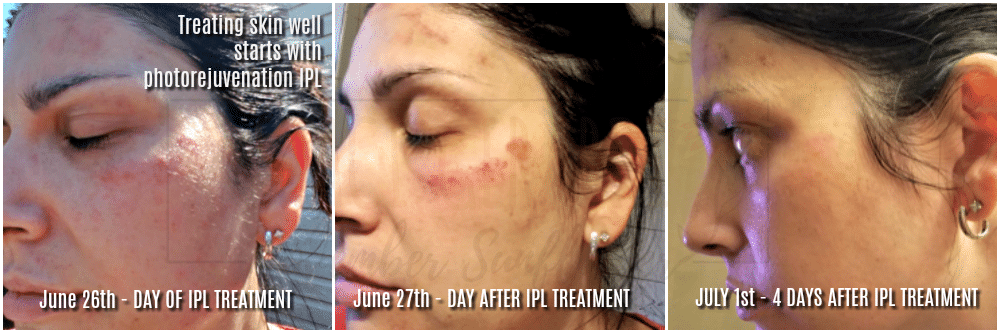 Treating skin well starts with photorejuvenation IPL