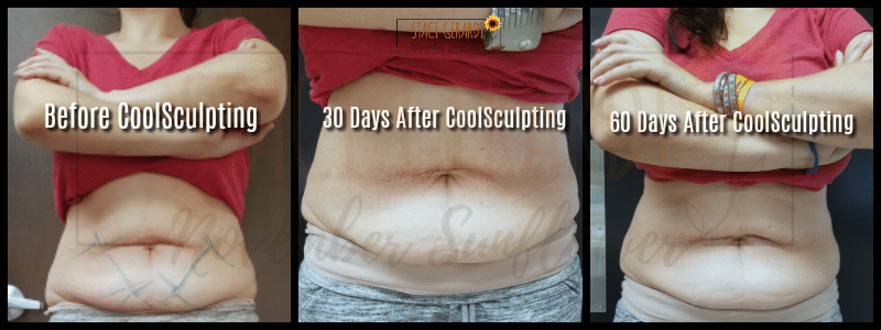 CoolSculpting Before and After Results