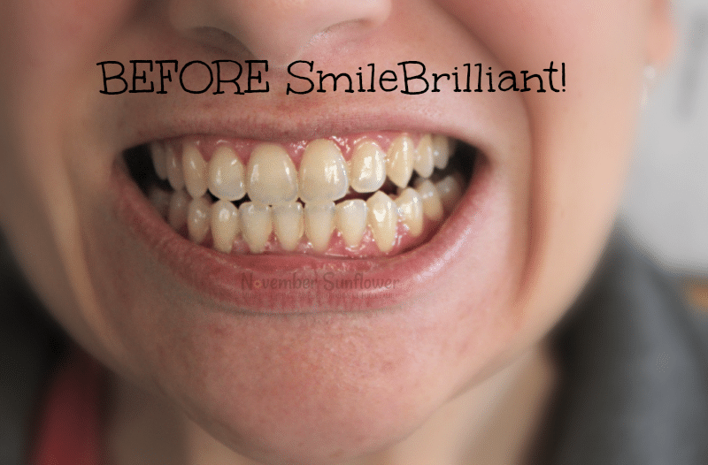SmileBrilliant! teeth whitening journey #sponsored #smilebrilliant